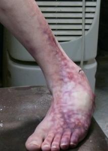 broken ankle sfx makeup prosthetic
